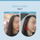 미희네 | 홍대 피부과 쥬베룩 볼륨 미희주사 차이점 후기