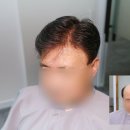 봉화의료용품전문점 | 자연스러운 변화 충남 금산가발 고객님 테이프 방식 새치가발 착용 후기