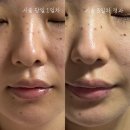 콜드플라즈마 | 대구 중구 ㅣ민감성 여드름 피부 콜드 플라즈마 첫 후기 ‘플라즈마 에스테틱‘