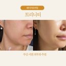트리니티 유도 | 부산서면피부과 트리니티 레이저리프팅 후기 통증없이 탄력 찾았어요