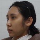 절골3 | 매부리코수술 꼭 해야할까? 절골이 필요한 진짜 기준