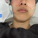 유진스의원 : 압구정 울쎄라프라임 두번째 방문(시술 후 주의사항, 가격, 효과, 부작용까지 완벽정리)