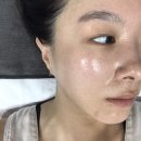 부산동래구피부관리 마리뷰티 여드름관리 플라즈마 받았어요