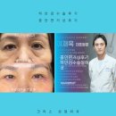 중안면거상술후기 하안검수술과 동시에 (하안검 성형외과 전문의)