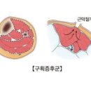 구획증후군 근육 압박에 의한 급성 증상 원인 치료 이미지