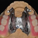 RPD치과기공소 이미지