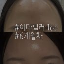 제이마젤 | [이마 필러] 이마 필러를 1cc만 맞는 사람이 있다? _ 6개월 차 후기
