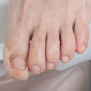 더플랜의원 | 내성발톱 통증 심했던 사촌동생 데리고 수원더셀의원 치료 후기 !