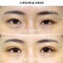 소시지눈재수술 방법의 중요성 &lt;디비 후기&gt;