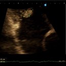 웰에이징김정혁내과의원 | 우연히 발견된 삼첨판막 첨판에 붙어있는 양성종양, 섬유 탄성종(탄성섬유종)? - 웰에이징 김정혁내과