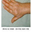 손마디 손가락 마디 부음 통증 이유 이미지