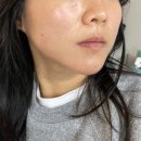 효병원1(도리티고개) | 울쎄라프라임 500샷 솔직후기(통증, 유지기간)