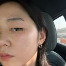 차앤유의원 | 점빼기 1일차|차앤유의원