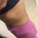 더베스트내과의원 | 대상포진… 단순 근육통인 줄 알았던 갈비뼈 통증의 정체