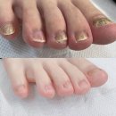 발닥터 | 구미 무좀 발닥터 관리 시술 (10)