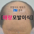 남성형 탈모 포기하셨다면?! 대량모발이식으로 극복!! 이미지