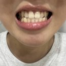서울라미플란트치과교정과치과의원 | 투명교정치과 가격 상담 후기! 인비절라인 시작