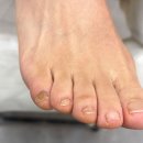 문제성 손, 발 오감네일 이미지