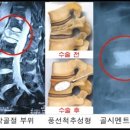 교통사고척추압박골절보상금받기/척추압박골절치료과 척추압박골절개인보험후유장애(후유장해)보험금 이미지