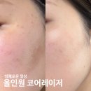 레이저보이 | 강남 잡티제거 모공강박걸의 코어레이저 솔직후기