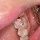 루트치과기공소 | 이쁜 어금니 잘생긴 어금니 통지르코니아 어금니 멋지다 mta pulpotomy
