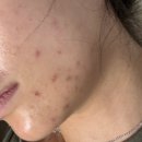 아젤리아 | 성인여드름 약국템 아젤리아 크림 내돈내산 후기 부작용 일주일 후기
