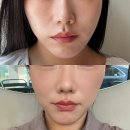 미희네 | 강남 피부과 미희주사 볼패임 해골 탈출 내돈내산 후기