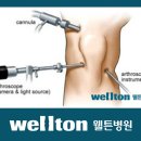 전방십자인대파열 ,관절내시경 수술 잘 하는 병원 ,십자인대파열 수술 이미지