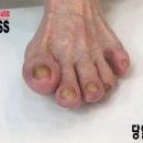 레푸스 서면점
