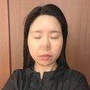 동탄 피부과 l 세 번째 방문 l 온다리프팅 후기 팔자주름 얼굴리프팅 관리