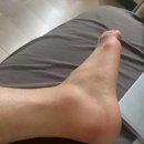 제일시장한의원 | 발목 접질렀을 때 한의원보다 효과 더 좋았던 방법