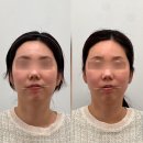 미본한의원 | [비대칭교정] 안면 비대칭 교정 5회차 "미본 강남점" 후기