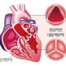 대동맥판막협착증 (심장, 인공판막) 이미지