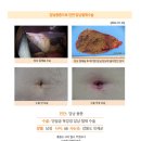 담낭용종수술후기. 용종 하나가 1cm 7mm라 수술해야 한다 해서 김정윤 원장님께 진료를 받고 수술을 했습니다. 이미지