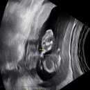 은하여성의원 | 임신 14주 차 초음파｜성별 확인 후기 &amp; 서브 병원 방문 기록