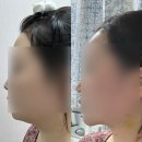 바보죽약국 | 이중턱 근육묶기 내돈내산 한달차 수술 후기