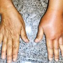 센트럴부산의원 | 부산 서면 유방암 림프도수 미슬토의원