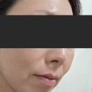 신풍약국 | [신풍역 피부과] 안톤의원, 얼굴위의 고민, 쥐젖 &amp; 편평사마귀 제거 후기