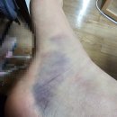 중동한의원 | [내 돈 내산] 부천 중동역/상동시장 "형예주한의원" 3번가 서 발목 멍 싹 뺏어요!