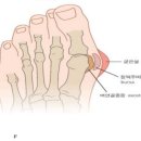 무지외반증의 원인인 평발! 예방법 및 원인 무지외반증교정기