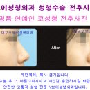 코성형, 미스코 필러주사 비용은? 대구성형외과 코수술, 쁘띠성형 잘하는곳 이미지