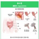 블로그 부활, 맹장수술후기(초기 증상 및 대응방법 등 A to Z)