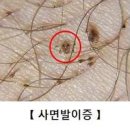 성병 사면발니 초기 증상 원인 사면발이 약 이미지