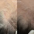당진중앙2로 | 탈모관리 효과 있을까? 당진 루크에스테틱 두피관리 3개월 12회차 리얼후기