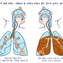 면역력은 폐활량과 비례한다. 가족력 치료방법 이미지