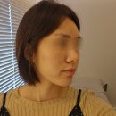 써니업 | 송도피부과 써마지 대신 써니리프팅 통증 솔직후기