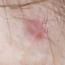 이뽀라성형외과의원 | [동탄 이뽀라 성형외과] 튀어나온점 뺀 후기