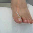 천안 내성발톱 레푸스 천안쌍용점 | 멍든 발톱 문제성 발 만족 관리 후기