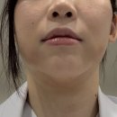 라인피디 | 울트라콜200으로 턱라인 / 이중턱 개선 후기 (실제 시술 경험)