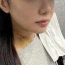 리모성형외과의원 | 이중턱살제거 비용 이중턱 근육묶기 흉터 일주일 리얼후기